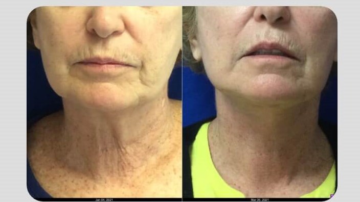 Dr. Suzman face lift and fat g